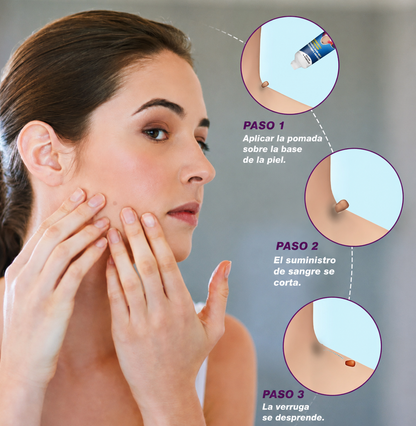 Wart Remover Cream - Eliminador de Verrugas