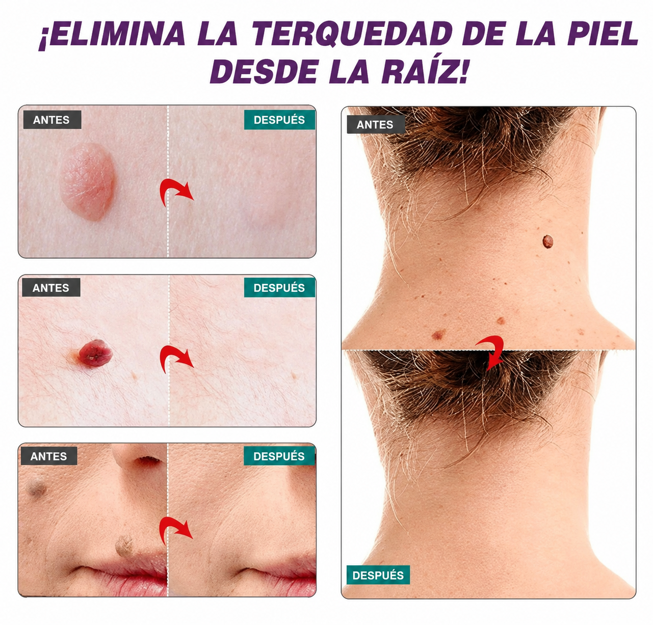 Wart Remover Cream - Eliminador de Verrugas